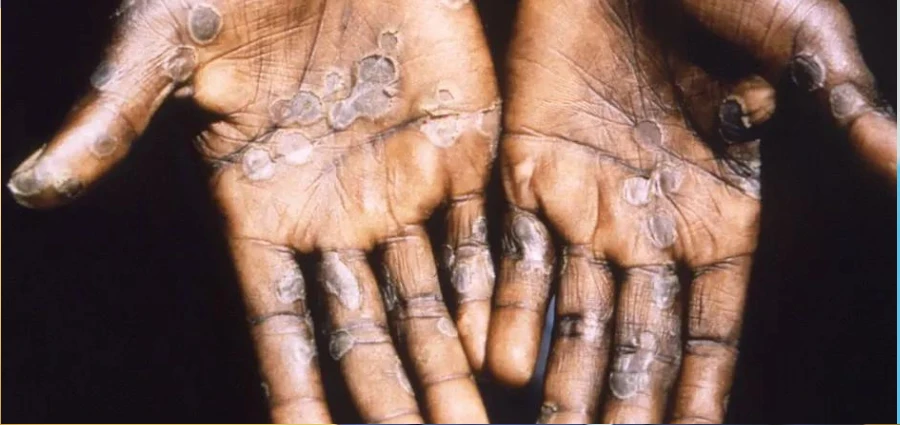 Image de Santé. Face à une menace sanitaire grandissante, le Ministère des Eaux et Forêts de Côte d'Ivoire a mis en place des mesures drastiques pour lutter contre la propagation de la variole du singe, ou Monkeypox. Ce virus, de plus en plus préoccupant, a conduit à une réaction ferme des autorités afin de protéger la santé publique. Le 6 août 2024, le ministère a publié un communiqué qui annonce l'interdiction formelle de la détention d'animaux sauvages vivants, soulignant ainsi la gravité de la situation et la nécessité de mesures préventives rigoureuses. Les Mesures Restrictives du Ministère des Eaux et Forêts En réponse à l'émergence de la variole du singe, le Ministère des Eaux et Forêts a pris des mesures de prévention strictes visant à limiter la propagation du virus. Le communiqué du 6 août précise que la détention d'animaux sauvages vivants, tels que les singes, chimpanzés, rats, et écureuils, est désormais interdite. Cette décision répond à une inquiétude croissante concernant la transmission du virus par ces animaux, souvent considérés comme des réservoirs naturels du pathogène. Laurent Tchagba, le ministre des Eaux et Forêts, a exprimé dans une déclaration que « la détention et la consommation de viande de brousse représentent un risque majeur pour la santé publique ». Selon lui, ces pratiques augmentent le potentiel de transmission de la variole du singe, qui peut se propager aux humains via le contact direct avec des animaux infectés ou par la consommation de leur viande. Le ministère appelle désormais toutes les personnes détenant ces animaux, que ce soit à des fins domestiques ou commerciales, à les remettre aux autorités compétentes d’ici le 31 août 2024. Cette mesure vise à réduire les risques de propagation du virus en limitant les sources potentielles de contamination. Les sanctions pour non-respect de cette interdiction sont sévères : les contrevenants risquent de 5 à 20 ans d'emprisonnement, ainsi que des amendes pouvant atteindre 100 millions de FCFA. Ces mesures draconiennes soulignent l'urgence de la situation et la détermination des autorités à enrayer la menace de la variole du singe. Laurent Tchagba a également lancé un appel au civisme et à la coopération de la population, soulignant que la lutte contre la variole du singe nécessite un effort collectif. « La collaboration de chaque citoyen est essentielle pour prévenir la propagation de cette maladie », a-t-il déclaré. En plus de l’interdiction des animaux sauvages, le ministère encourage également la population à signaler toute activité suspecte relative à la détention ou à la vente de viande de brousse. Le gouvernement ivoirien n'est pas seul dans cette lutte ; il a également sollicité l'aide de la communauté internationale pour renforcer les capacités de surveillance et de réponse face à cette épidémie. Contexte Épidémiologique et Réponses des Autorités La variole du singe, bien que moins virulente que la variole humaine, est une maladie potentiellement grave. Elle se manifeste par des symptômes similaires à ceux de la variole, notamment la fièvre, les maux de tête, les douleurs musculaires, l’enflure des ganglions, et des éruptions cutanées. La récente confirmation de deux cas de variole du singe en Côte d'Ivoire, annoncée le 30 juillet par le ministère de la Santé, de l'Hygiène publique et de la Couverture maladie universelle, a mis en lumière la nécessité de mesures préventives strictes. Cette situation alarmante a conduit les autorités à agir rapidement pour éviter une propagation plus large de la maladie. Le gouvernement a intensifié les efforts de surveillance et a renforcé les équipes médicales pour gérer les cas suspects et confirmés. Les autorités sanitaires continuent de travailler en étroite collaboration avec des experts internationaux pour garantir une réponse efficace à cette épidémie. La question qui se pose désormais est de savoir si ces mesures seront suffisantes pour contrôler efficacement la propagation de la variole du singe en Côte d'Ivoire. Le défi réside non seulement dans l'application rigoureuse des nouvelles régulations mais aussi dans la capacité du système de santé à gérer une éventuelle augmentation des cas. La lutte contre les maladies zoonotiques, telles que la variole du singe, nécessite une approche intégrée qui combine des mesures de prévention, des interventions médicales rapides et une sensibilisation continue de la population. À cet égard, les autorités ivoiriennes doivent-elles envisager d'autres mesures pour renforcer la surveillance et la gestion des risques sanitaires ? En conclusion, l'efficacité de la réponse du gouvernement à cette crise sanitaire dépendra largement de la coopération de la population et de la capacité du système de santé à s'adapter aux défis posés par la variole du singe. Quelles seront les prochaines étapes pour assurer un contrôle durable et efficace de cette maladie en Côte d'Ivoire ?