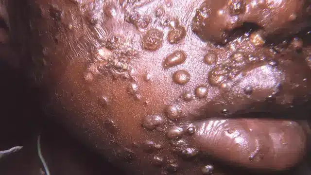 Image de Santé. La Côte d'Ivoire fait face à une recrudescence inquiétante de la variole du singe, aussi appelée mpox. Selon les derniers rapports de l’Institut national de l’hygiène publique (INHP), 28 nouveaux cas ont été confirmés à Abidjan jusqu'au 20 août 2024, dont un cas mortel. Cette montée en flèche des cas marque un tournant significatif dans la gestion de cette maladie, et appelle à une mobilisation accrue des autorités sanitaires ainsi que de la population. Les mesures prises et les défis rencontrés illustrent une situation en évolution rapide, soulignant la nécessité d'une réponse coordonnée et efficace. Une Épidémie en Expansion : Bilan Actuel et Réponse Sanitaire La Côte d'Ivoire se trouve actuellement en alerte face à une montée significative des cas de variole du singe. Le docteur Daouda Coulibaly, porte-parole de l’INHP, a précisé que l’épidémie, qui a vu un nombre de cas grimper de six au début du mois à 28 cas confirmés, exige une réponse urgente. "Il est impératif de renforcer notre surveillance pour briser les chaînes de transmission de la variole du singe", a-t-il affirmé. L'INHP a mis en place des stratégies pour identifier les contacts des personnes infectées, les isoler et les suivre de près pour prévenir toute propagation supplémentaire. Cette évolution rapide de l'épidémie marque un contraste frappant avec la situation plus stable rapportée au début du mois d'août. La montée en puissance des cas, incluant un décès, met en lumière la vitesse à laquelle les épidémies peuvent se propager et la nécessité d'une réaction rapide et efficace pour contenir la situation. Les autorités sanitaires sont désormais face à un défi majeur pour contrôler la propagation du virus et protéger la santé publique. La recrudescence de la variole du singe en Côte d'Ivoire ne s'inscrit pas dans un contexte isolé. Au niveau régional, l’épidémie a également touché d'autres pays africains, avec la République démocratique du Congo (RDC) en tête de liste. La RDC est le pays le plus touché, avec plus de 16 000 cas enregistrés et 548 décès à ce jour. L'émergence d'un nouveau variant, le clade 1b, a accentué les inquiétudes. Ce variant, identifié en septembre 2023, est non seulement plus transmissible, mais aussi potentiellement plus mortel. Sa propagation a désormais atteint d'autres pays africains et même l’Europe du Nord, avec des cas signalés en Suède. L'émergence de ce variant souligne l'importance de la surveillance internationale et de la coopération en matière de santé publique. La capacité à détecter et à comprendre les variations génétiques du virus est cruciale pour élaborer des stratégies de prévention et de traitement adaptées. Cette dynamique régionale et internationale influence directement la réponse en Côte d'Ivoire et souligne la nécessité d'une approche coordonnée pour faire face à l'épidémie. Réactions Internationales et Mesures de Prévention Face à la recrudescence de la variole du singe, l'Organisation mondiale de la santé (OMS) a déclaré le 14 août une urgence de santé publique de portée internationale. Cette déclaration vise à mobiliser des ressources mondiales et à renforcer la coopération internationale pour contenir la propagation du virus. "Cette déclaration marque un tournant dans notre approche pour contenir l'épidémie. Nous devons unir nos efforts pour stopper la propagation et protéger les communautés les plus vulnérables", a déclaré un représentant de l'OMS. En réponse à cette déclaration, les autorités ivoiriennes ont intensifié leurs efforts de surveillance et d'analyse. Elles se concentrent sur la compréhension des nouvelles souches du virus et sur la mise en œuvre de mesures de prévention adaptées. La situation actuelle reste sous contrôle, mais les experts appellent à une vigilance accrue. La coopération de la population est essentielle pour éviter une propagation incontrôlée. Les autorités sanitaires ivoiriennes travaillent à renforcer les capacités de détection et à améliorer les infrastructures de santé pour gérer les cas de variole du singe. Elles mettent également en œuvre des campagnes de sensibilisation pour informer la population sur les mesures de prévention, telles que l'isolement des cas suspects et l'hygiène personnelle renforcée. L'augmentation rapide des cas de variole du singe en Côte d'Ivoire pose plusieurs défis importants. Les autorités sanitaires doivent non seulement gérer les cas existants mais aussi anticiper la propagation potentielle du virus. La gestion de cette épidémie nécessite une coordination étroite entre les différents acteurs de la santé publique, y compris les institutions gouvernementales, les organisations non gouvernementales et les communautés locales. Un défi majeur reste la capacité à maintenir des niveaux élevés de surveillance et de réponse tout en s'assurant que les infrastructures de santé peuvent gérer l'afflux de cas. Les ressources disponibles pour le traitement et l'isolement des patients, ainsi que pour les campagnes de sensibilisation, seront cruciales pour contrôler l'épidémie. En parallèle, la collaboration internationale et la recherche scientifique continueront de jouer un rôle clé. Les efforts pour comprendre les variations génétiques du virus et développer des interventions efficaces doivent être soutenus par des politiques de santé publique robustes. Alors que la Côte d'Ivoire fait face à cette nouvelle vague d'épidémie, une question demeure : quelles stratégies et collaborations internationales seront nécessaires pour maîtriser efficacement l'épidémie de variole du singe et prévenir sa propagation future en Afrique et au-delà ?