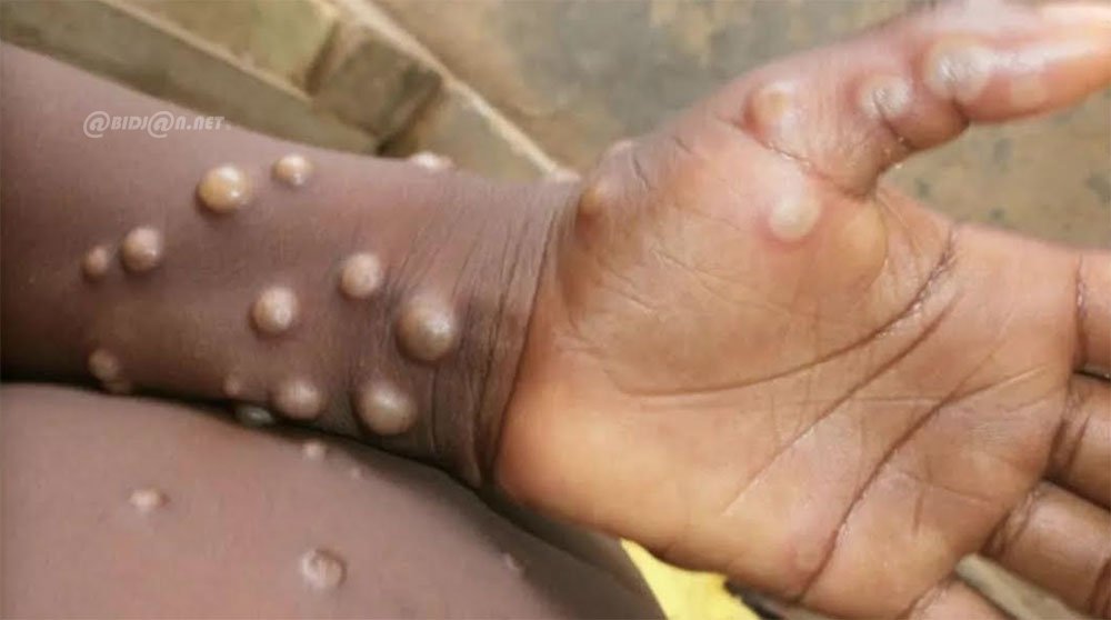 Image de Santé. La Côte d'Ivoire est confrontée à une nouvelle crise sanitaire. La variole du singe, également connue sous le nom de mpox, prend de l'ampleur dans plusieurs régions du pays. À la date du 24 août 2024, les autorités sanitaires ont enregistré plus de 30 cas confirmés. Cette situation inquiétante nécessite une vigilance accrue et des mesures de prévention rigoureuses pour éviter une propagation massive. Comment le pays fait-il face à cette épidémie, et quelles sont les mesures mises en place pour en limiter les effets ? Un Bilan Alarmant : 32 Cas Confirmés et un Décès Le ministère de la Santé, de l'Hygiène Publique et de la Couverture Maladie Universelle a publié un rapport alarmant sur l'état de l'épidémie de variole du singe en Côte d'Ivoire. Selon ce document, le pays compte actuellement 32 cas confirmés, répartis dans 15 districts sanitaires sur un total de 113. Parmi ces cas, six personnes sont considérées comme guéries, tandis qu'un décès a été enregistré. Ce décès concerne un patient qui présentait des facteurs de risque aggravants, selon les autorités sanitaires. Pierre Dimba, ministre de la Santé, a déclaré dans un communiqué que "les foyers d'infection identifiés à ce jour ne montrent pas de lien épidémiologique direct entre eux." Cette situation complique les efforts de traçage des contacts et de confinement du virus, car elle suggère une propagation sporadique et imprévisible de la maladie. L'absence de formes graves en hospitalisation, selon le ministre, pourrait néanmoins être interprétée comme un signe encourageant. Néanmoins, les autorités restent prudentes, soulignant la nécessité d'un suivi rigoureux des 272 cas contacts identifiés dans les districts concernés. La variole du singe est une maladie virale zoonotique qui peut se transmettre de l'animal à l'homme, mais également entre humains. En Côte d'Ivoire, les autorités sanitaires ont identifié la consommation de viande de brousse comme un facteur de risque majeur. "La consommation de viande de brousse, qui reste une pratique courante dans plusieurs régions du pays, favorise la transmission du virus aux humains," a précisé Pierre Dimba. Outre la consommation de viande de brousse, la contamination interhumaine est également un mode de transmission important. Les cas surviennent souvent lorsque les malades ne sont pas isolés et continuent d'avoir des contacts fréquents avec leurs proches. "Il est impératif d'isoler les patients dès l'apparition des premiers symptômes pour éviter la transmission à grande échelle," a averti le ministre. Le district sanitaire de Dianra est actuellement le plus touché avec 9 cas confirmés et 8 cas suspects. Cette concentration de cas dans un district particulier pourrait indiquer une faille dans les mesures de contrôle ou un retard dans la mise en œuvre des protocoles de prévention. Les Mesures de Prévention et de Contrôle en Place Face à l'augmentation des cas de variole du singe, le gouvernement ivoirien a renforcé les mesures de prévention et de contrôle. Les autorités sanitaires encouragent le respect strict des mesures d'hygiène, notamment le lavage régulier des mains avec du savon et l'utilisation d'équipements de protection individuelle (EPI) tels que les masques et les gants. Le ministre Pierre Dimba a également insisté sur la nécessité de maintenir une distanciation physique étroite avec les personnes infectées. "Les mesures de prévention sont essentielles pour limiter la propagation du virus," a souligné le ministre. Il a ajouté que le gouvernement intensifie ses efforts pour sensibiliser les populations sur les dangers de la consommation de viande de brousse et sur l'importance de respecter les consignes de sécurité sanitaire. En plus des mesures de prévention individuelle, des équipes de santé publique sont déployées dans les districts touchés pour surveiller la situation et fournir des soins aux patients infectés. Les autorités sanitaires travaillent également en étroite collaboration avec les organisations internationales de santé pour renforcer la capacité de diagnostic et de traitement de la variole du singe en Côte d'Ivoire. Malgré les efforts déployés par le gouvernement, plusieurs défis subsistent. L'un des principaux obstacles à une réponse efficace est la coordination des efforts entre les différentes régions. La dispersion des cas dans 15 districts sanitaires sans lien apparent entre eux rend difficile la mise en place d'une stratégie de confinement uniforme. De plus, le système de santé ivoirien, déjà fragilisé par d'autres épidémies et par des ressources limitées, pourrait peiner à contenir une propagation plus large. Le manque d'infrastructures de santé adéquates dans les zones rurales, où la consommation de viande de brousse est la plus courante, complique davantage la situation. Les experts en santé publique soulignent également la nécessité d'un meilleur accès aux vaccins et aux traitements antiviraux. "Il est crucial de renforcer la chaîne d'approvisionnement des vaccins contre la variole du singe et de garantir un accès équitable à ces ressources," a déclaré un représentant de l'Organisation mondiale de la santé en Côte d'Ivoire. Le Rôle des Communautés et de la Sensibilisation La lutte contre la variole du singe ne peut se faire sans l'implication active des communautés locales. Les autorités sanitaires mettent en avant l'importance de la sensibilisation et de l'éducation sanitaire pour prévenir de nouvelles infections. Des campagnes d'information sont menées dans les médias locaux et les réseaux sociaux pour informer le public des symptômes de la maladie, des moyens de prévention et des actions à entreprendre en cas de suspicion d'infection. "La mobilisation communautaire est essentielle pour lutter contre la variole du singe," a affirmé un responsable de la santé publique. "Les chefs traditionnels, les leaders religieux et les organisations locales jouent un rôle clé dans la diffusion de messages de prévention et dans l'encouragement des bonnes pratiques." Les autorités encouragent également les communautés à signaler rapidement tout cas suspect aux centres de santé les plus proches afin d'assurer un diagnostic précoce et de limiter la propagation du virus. À mesure que l'épidémie progresse, la nécessité d'une stratégie nationale plus cohérente devient de plus en plus évidente. Les experts en santé publique appellent à une réponse coordonnée impliquant toutes les parties prenantes, y compris le gouvernement, les organisations internationales, les acteurs du secteur privé et les communautés locales. Des discussions sont en cours pour renforcer les capacités de surveillance épidémiologique, améliorer les infrastructures de santé et intensifier la recherche sur la variole du singe. L'objectif est de développer une réponse plus résiliente et durable aux futures épidémies. La variole du singe représente un défi majeur pour la Côte d'Ivoire, qui doit naviguer entre la gestion de l'épidémie actuelle et la prévention d'une éventuelle propagation future. Les mesures mises en place par les autorités sont un pas dans la bonne direction, mais la route reste longue. Les efforts de sensibilisation, la mobilisation communautaire et le renforcement des infrastructures de santé sont essentiels pour contenir la maladie. Alors que la situation continue d'évoluer, une question cruciale demeure : comment la Côte d'Ivoire peut-elle renforcer sa capacité à prévenir et à répondre à de telles crises sanitaires à l'avenir, tout en minimisant les impacts sociaux et économiques ?