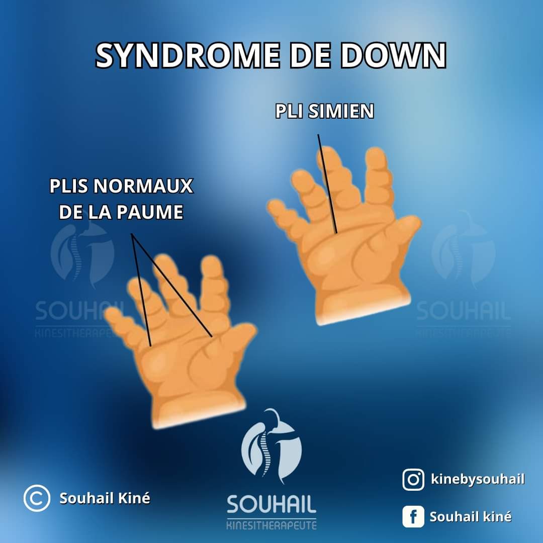 Image de Santé. La Journée nationale de la Trisomie 21 est un événement annuel en France, organisé par Trisomie 21 France pour soutenir l'inclusion des 40 000 personnes atteintes de cette condition. Célébrée le 19 novembre 2023, cette journée vise à favoriser l'intégration des personnes atteintes de trisomie 21, en particulier dans les environnements scolaires et professionnels. La trisomie, une anomalie chromosomique, se manifeste par un chromosome supplémentaire dans l'une des 23 paires de chromosomes humains. Bien que la trisomie 21 soit la plus reconnue, d'autres formes existent, telles que la trisomie 13, la trisomie 18, et la trisomie 8, chacune avec des implications différentes en fonction des chromosomes touchés. Certaines trisomies sont létales, entraînant la mort du fœtus, tandis que d'autres affectent les chromosomes sexuels, telles que la trisomie X, la trisomie XXY et la trisomie XYY. Chaque 21 mars est consacré à la Journée mondiale de la Trisomie, mais en France, le 19 novembre est spécifiquement dédié à la trisomie 21. Cette année, Trisomie 21 France, en collaboration avec une cinquantaine d'associations, met l'accent sur l'inclusion dans les milieux éducatifs et professionnels. Leur objectif est de promouvoir une société plus inclusive qui reconnaît les besoins spécifiques des personnes atteintes de trisomie. L'inclusion commence dès l'enfance, à l'école, et se poursuit tout au long de la vie professionnelle pour assurer une meilleure qualité de vie. Pour cette journée nationale, des événements locaux seront organisés par les associations locales, encourageant également les témoignages pour illustrer les rêves et les expériences quotidiennes à l'école ou au travail. La couleur emblématique de cette journée sera le vert, symbole d'espoir et de solidarité pour favoriser l'inclusion. Dans cette optique, la semaine européenne de l'emploi des personnes handicapées, prévue du 20 au 26 novembre 2023, prolongera cette sensibilisation. Comment percevez-vous l'importance de l'inclusion des personnes atteintes de trisomie 21 dans la société et quels changements pensez-vous nécessaires pour y parvenir ?