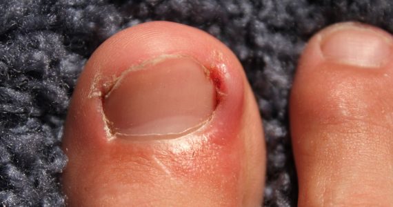 Image de Beauté/Mode. La première étape cruciale dans la gestion d'un ongle incarné est la compréhension approfondie de la condition. J'ai cherché à démystifier les causes sous-jacentes, les facteurs de risque et les symptômes associés. Grâce à cette recherche approfondie, j'ai acquis une perspective éclairée sur la nature de l'ongle incarné, ce qui a grandement influencé mes choix de traitement. Une approche courante que j'ai explorée est l'utilisation de bains de pieds chauds et de trempages. Ces pratiques simples mais efficaces ont démontré leur capacité à soulager l'inconfort et à assouplir la peau autour de l'ongle incarné. Mon expérience personnelle m'a permis d'ajuster les paramètres de température et de durée pour maximiser les bienfaits de cette méthode. En parallèle, j'ai exploré l'utilisation de solutions topiques et d'onguents spécialement conçus pour traiter les ongles incarnés. Cette approche a nécessité une sélection minutieuse des produits disponibles sur le marché, en tenant compte de leur composition, de leur efficacité et de leur compatibilité avec ma peau. Les résultats de cette démarche ont été variés, soulignant l'importance de choisir des produits de qualité. Cependant, il est crucial de noter que certaines situations d'ongles incarnés peuvent nécessiter une intervention plus directe. J'ai donc exploré les techniques d'auto-traitement, telles que le relevage délicat de l'ongle à l'aide d'un coton, ainsi que l'utilisation de petits dispositifs médicaux conçus pour réduire la pression sur l'ongle. L'idée d'une intervention professionnelle n'était pas écartée. J'ai cherché à comprendre les procédures que les podologues et les spécialistes des pieds mettent en œuvre pour résoudre ce problème. Cette exploration m'a fourni des informations précieuses sur les options médicales disponibles, élargissant mes choix de traitement. Le volet préventif de la gestion des ongles incarnés a également retenu mon attention. À travers mes recherches, j'ai découvert des pratiques simples mais essentielles pour éviter la récurrence de ce problème dérangeant. Des conseils sur le choix de chaussures appropriées, la coupe adéquate des ongles et d'autres habitudes préventives ont enrichi ma compréhension globale de la santé des pieds. Mon parcours pour traiter un ongle incarné m'a également amené à évaluer l'impact psychologique de cette condition. Les moments d'inconfort physique peuvent souvent être accompagnés d'une détresse émotionnelle. J'ai exploré des approches de gestion du stress et de la frustration liés à cette situation, reconnaissant l'importance de l'équilibre mental dans le processus de guérison. En réfléchissant sur cette expérience personnelle, je conclus que la gestion d'un ongle incarné est une quête multifacette qui nécessite une approche holistique. Les techniques et conseils efficaces varient d'une personne à l'autre, soulignant l'importance de la personnalisation du traitement. Mon exploration m'a armé d'une compréhension approfondie et d'outils pratiques pour aborder cette condition avec confiance et résolution.